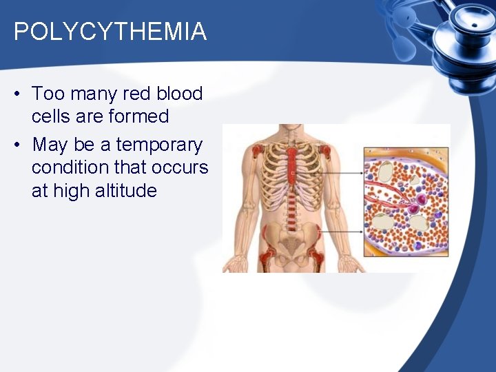 POLYCYTHEMIA • Too many red blood cells are formed • May be a temporary
