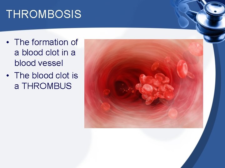 THROMBOSIS • The formation of a blood clot in a blood vessel • The