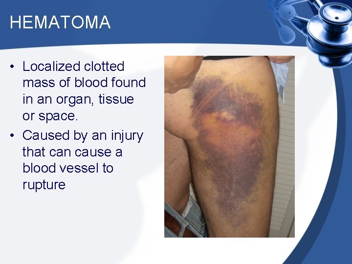 HEMATOMA • Localized clotted mass of blood found in an organ, tissue or space.