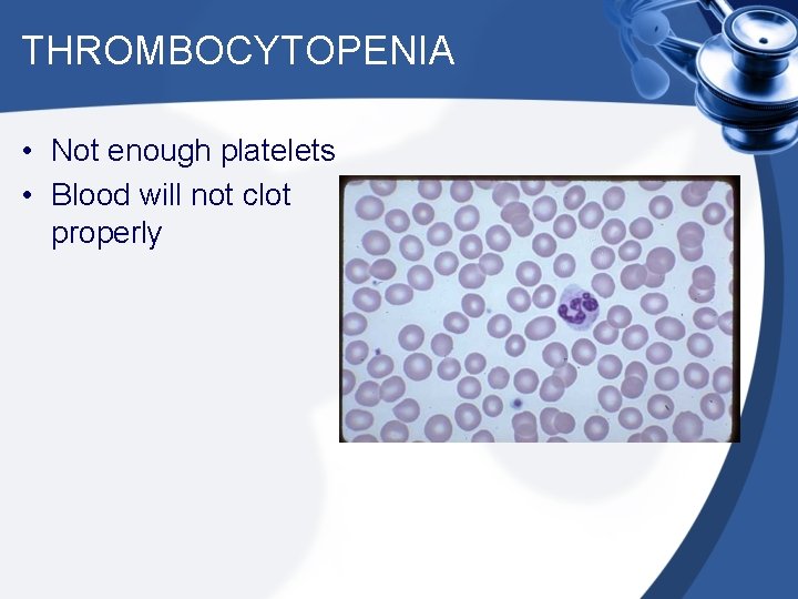 THROMBOCYTOPENIA • Not enough platelets • Blood will not clot properly 