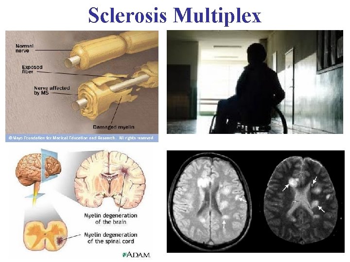 Sclerosis Multiplex 
