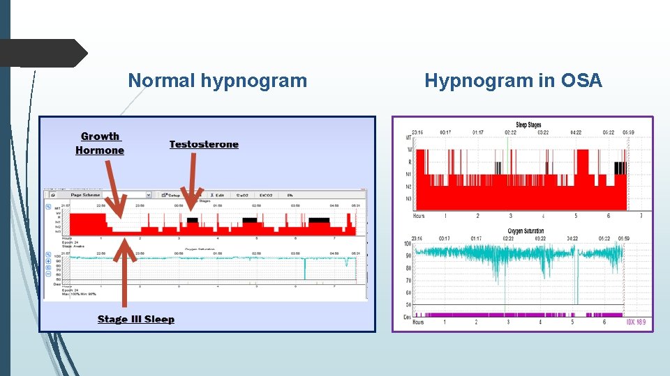 Normal hypnogram Hypnogram in OSA 