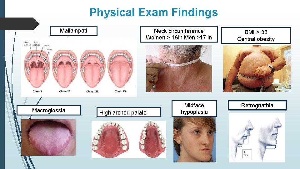 Physical Exam Findings Mallampati Macroglossia Neck circumference Women > 16 in Men >17 in