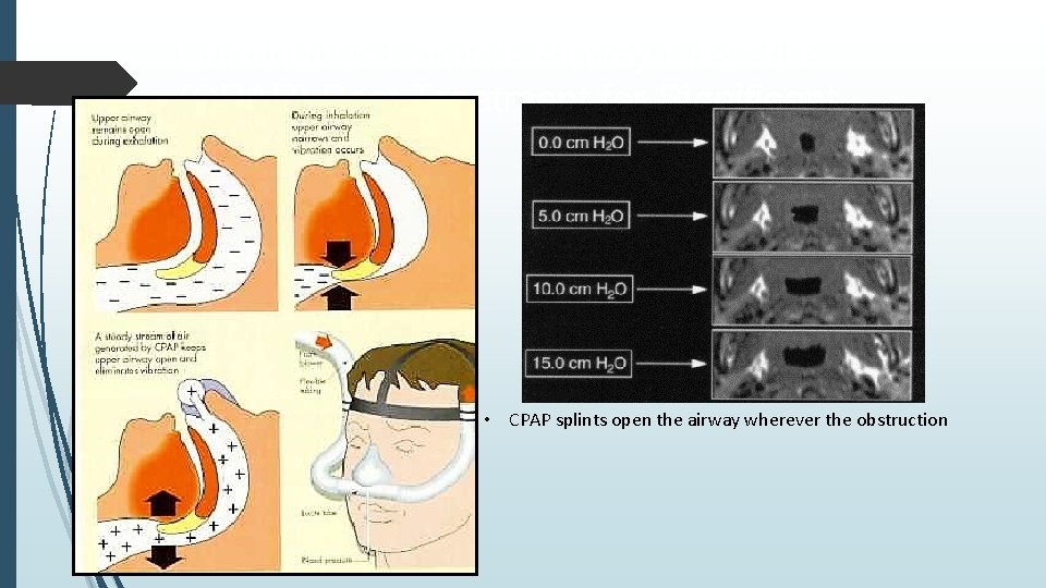 Continuous Positive Airway Pressure (CPAP) Best Treatment for Significant OSA • CPAP splints open