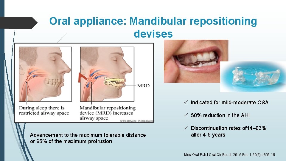 Oral appliance: Mandibular repositioning devises ü Indicated for mild-moderate OSA ü 50% reduction in