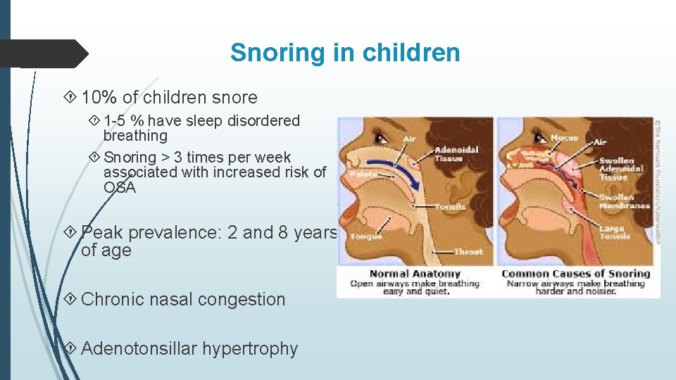 Snoring in children 10% of children snore 1 -5 % have sleep disordered breathing