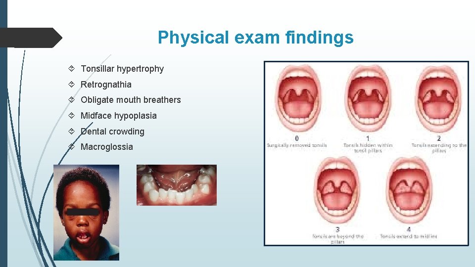 Physical exam findings Tonsillar hypertrophy Retrognathia Obligate mouth breathers Midface hypoplasia Dental crowding Macroglossia