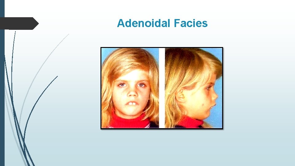 Adenoidal Facies 