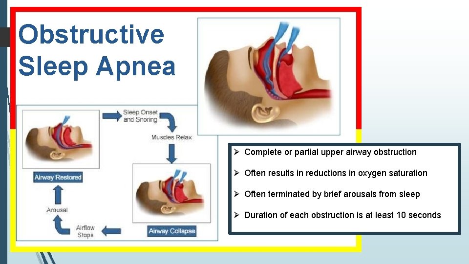 Obstructive Sleep Apnea Ø Complete or partial upper airway obstruction Ø Often results in