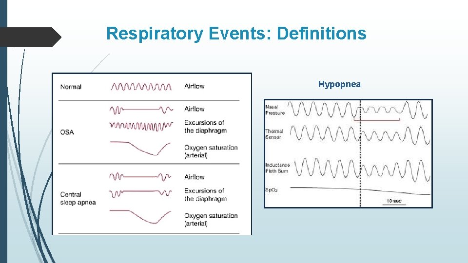 Respiratory Events: Definitions Hypopnea 