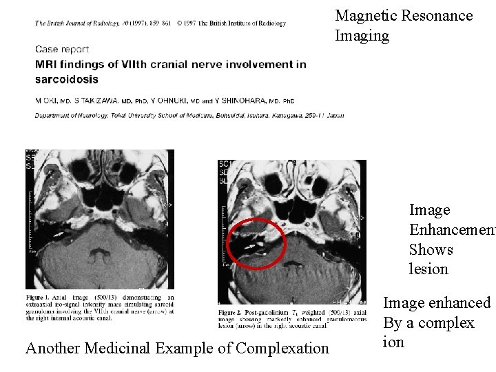 Magnetic Resonance Imaging Image Enhancement Shows lesion Another Medicinal Example of Complexation Image enhanced