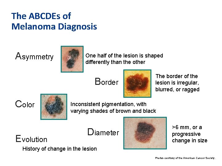 The ABCDEs of Melanoma Diagnosis Asymmetry One half of the lesion is shaped differently