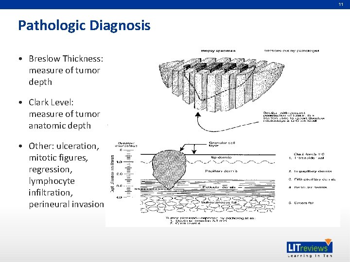 11 Pathologic Diagnosis • Breslow Thickness: measure of tumor depth • Clark Level: measure
