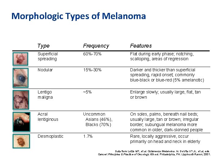 Morphologic Types of Melanoma Type Frequency Features Superficial spreading 60%-70% Flat during early phase;