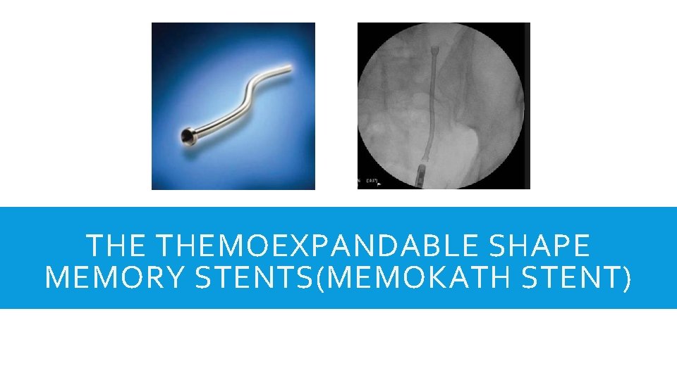 THE THEMOEXPANDABLE SHAPE MEMORY STENTS(MEMOKATH STENT) 