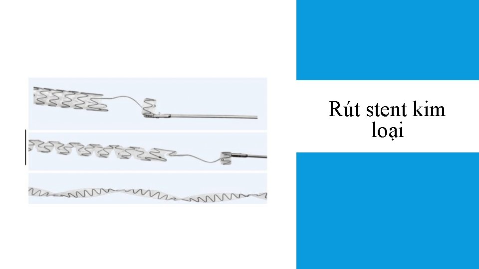 Rút stent kim loại 