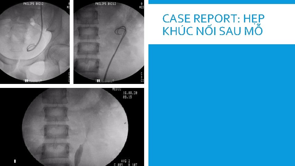 CASE REPORT: HẸP KHÚC NỐI SAU MỖ 