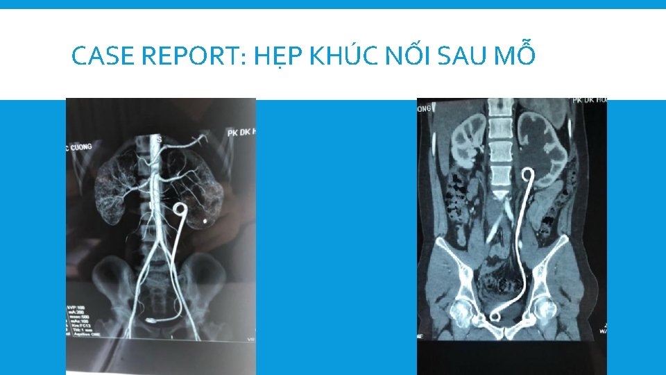 CASE REPORT: HẸP KHÚC NỐI SAU MỖ 