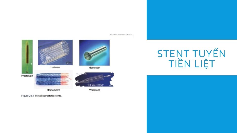 STENT TUYẾN TIỀN LIỆT 