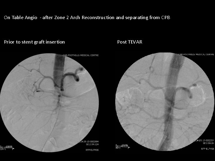On Table Angio - after Zone 2 Arch Reconstruction and separating from CPB Prior