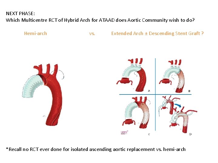 NEXT PHASE: Which Multicentre RCT of Hybrid Arch for ATAAD does Aortic Community wish