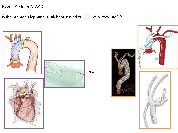 Hybrid Arch for ATAAD Is the Stented Elephant Trunk best served “FROZEN” or “WARM”