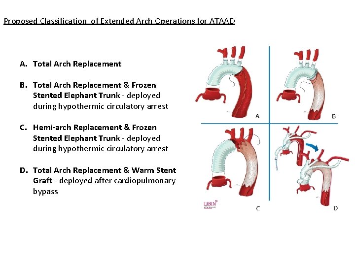 Proposed Classification of Extended Arch Operations for ATAAD A. Total Arch Replacement B. Total