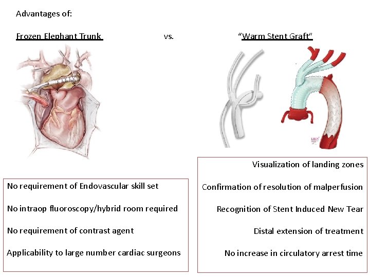 Advantages of: Frozen Elephant Trunk vs. “Warm Stent Graft” Visualization of landing zones No