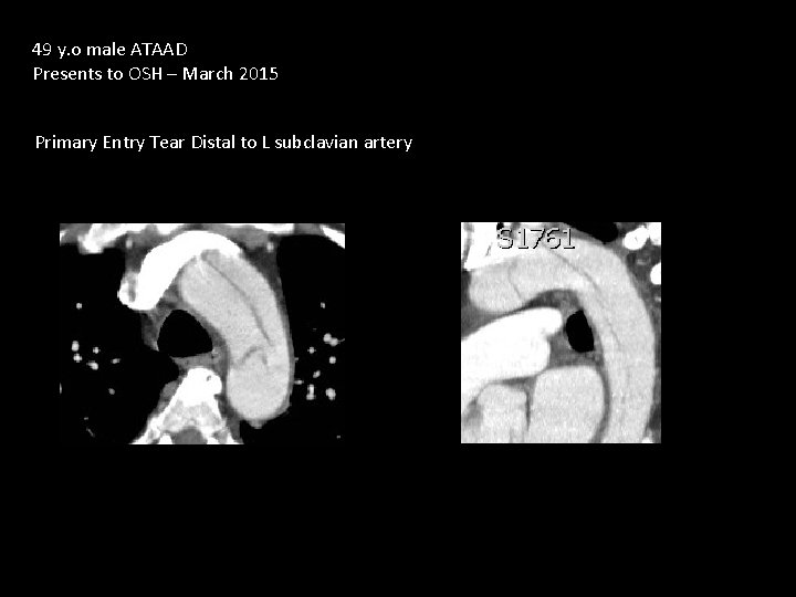 49 y. o male ATAAD Presents to OSH – March 2015 Primary Entry Tear