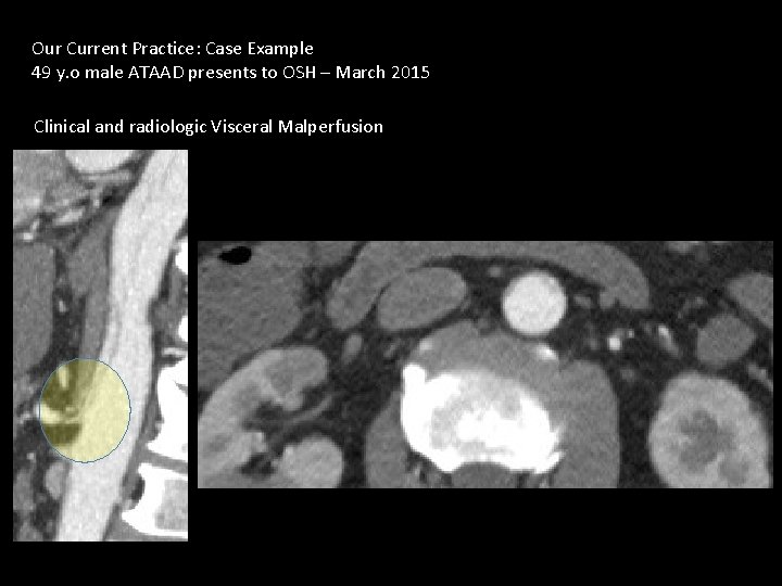 Our Current Practice: Case Example 49 y. o male ATAAD presents to OSH –