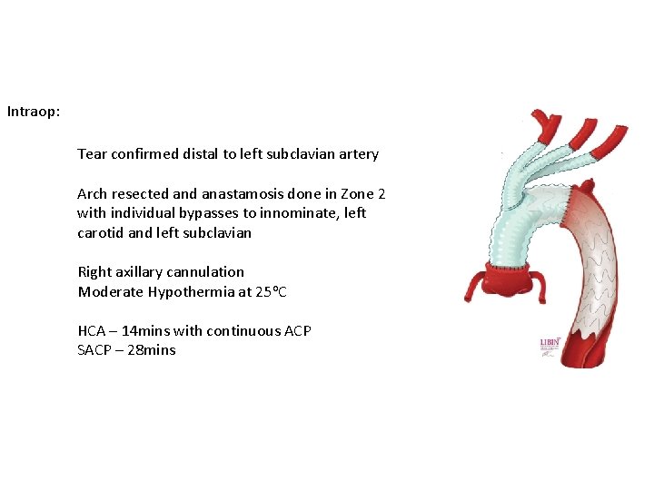 Intraop: Tear confirmed distal to left subclavian artery Arch resected anastamosis done in Zone