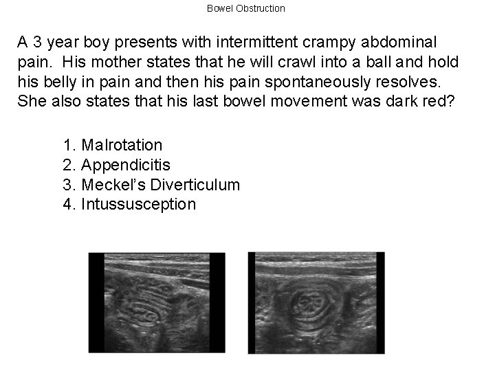 Bowel Obstruction A 3 year boy presents with intermittent crampy abdominal pain. His mother