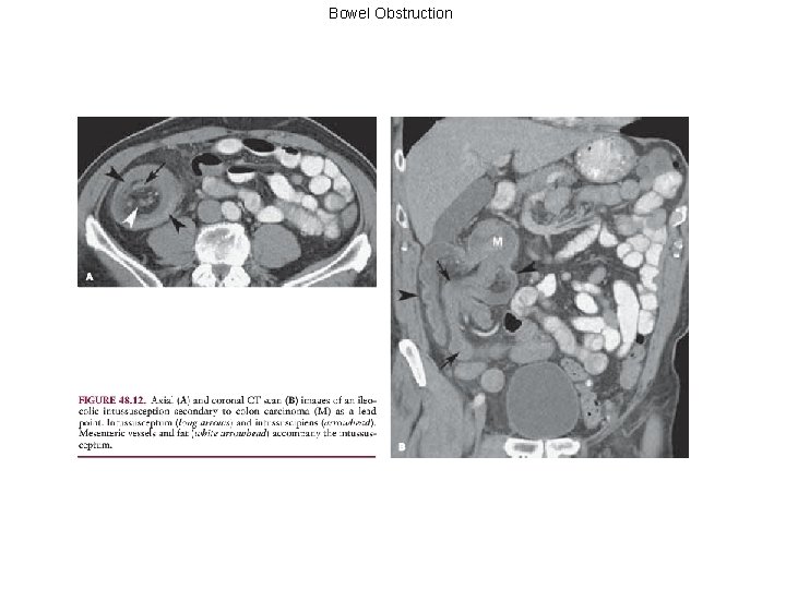 Bowel Obstruction 