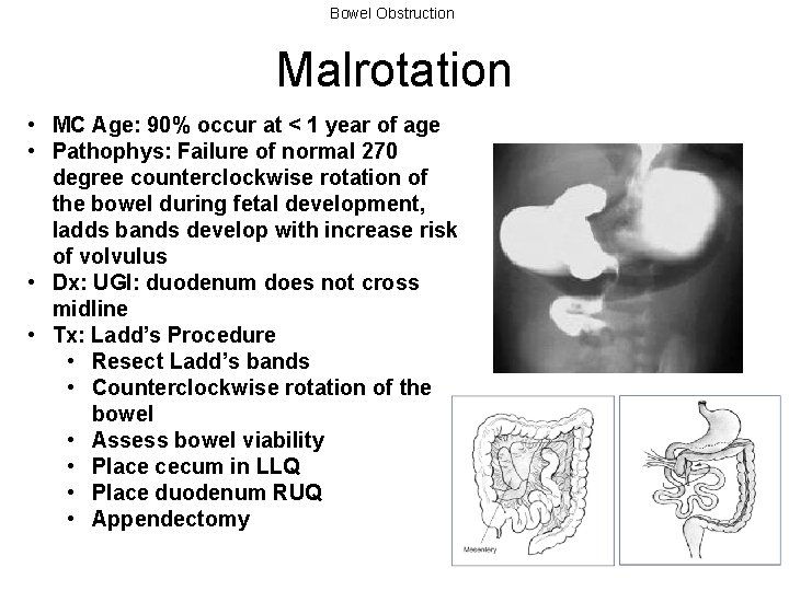 Bowel Obstruction Malrotation • MC Age: 90% occur at < 1 year of age