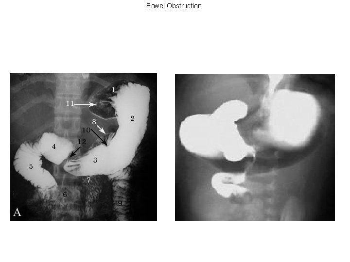 Bowel Obstruction 