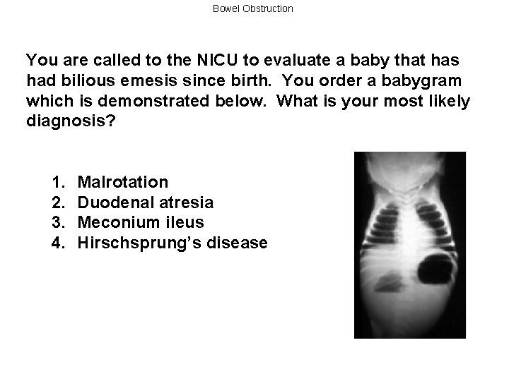 Bowel Obstruction You are called to the NICU to evaluate a baby that has