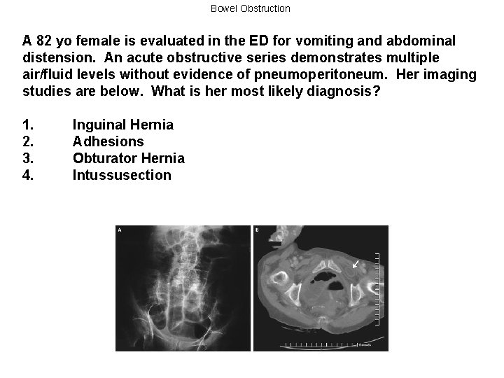 Bowel Obstruction A 82 yo female is evaluated in the ED for vomiting and