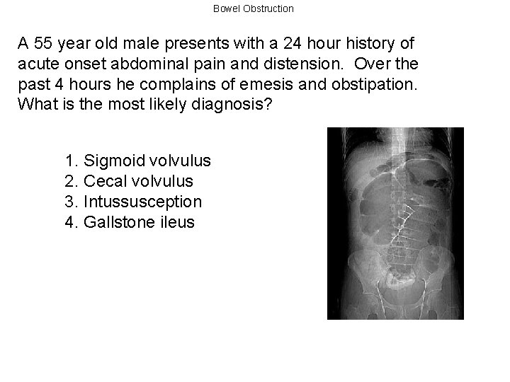 Bowel Obstruction A 55 year old male presents with a 24 hour history of