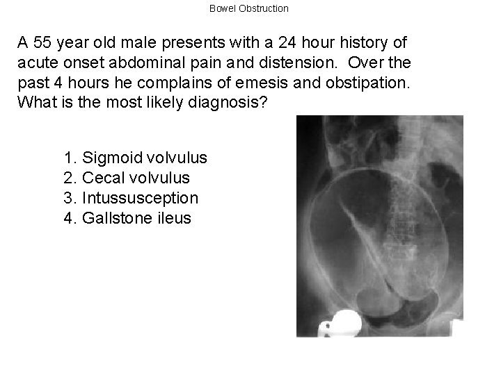 Bowel Obstruction A 55 year old male presents with a 24 hour history of