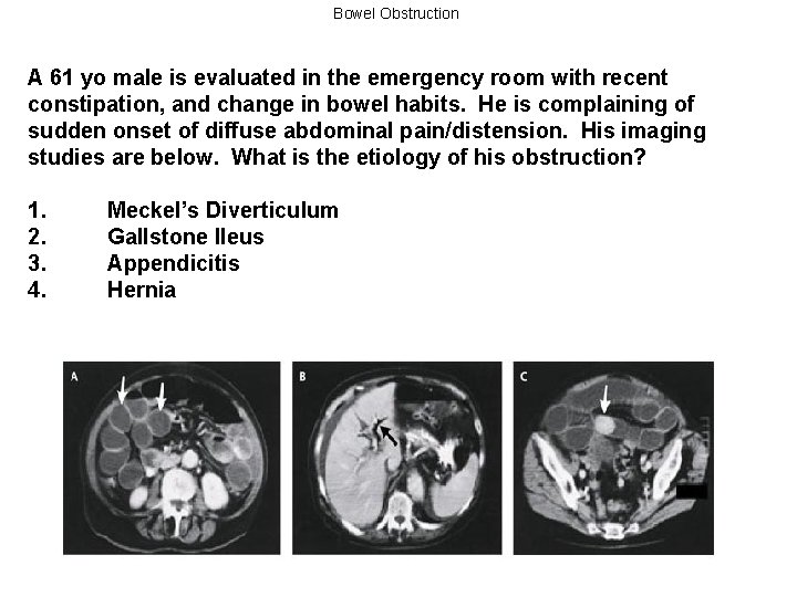 Bowel Obstruction A 61 yo male is evaluated in the emergency room with recent