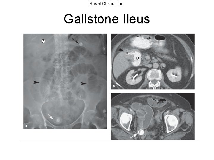 Bowel Obstruction Gallstone Ileus 