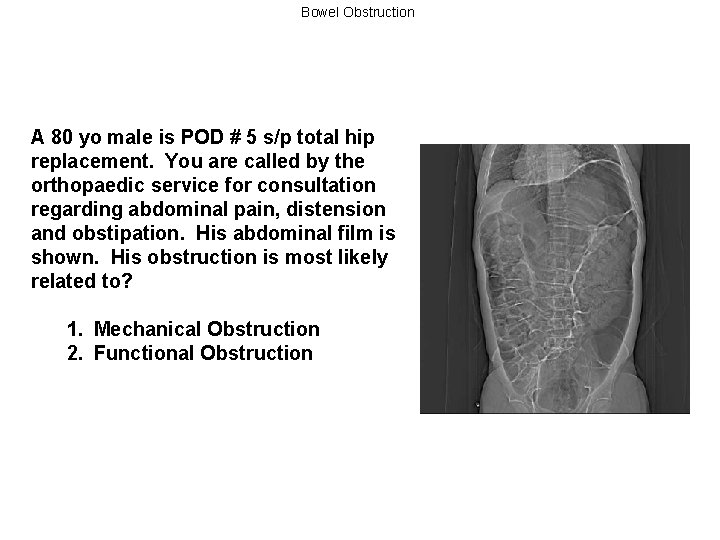 Bowel Obstruction A 80 yo male is POD # 5 s/p total hip replacement.