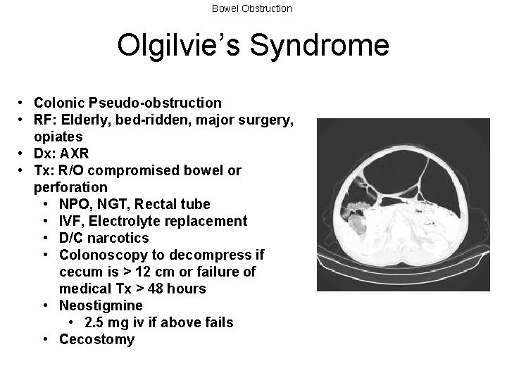 Bowel Obstruction Olgilvie’s Syndrome • Colonic Pseudo-obstruction • RF: Elderly, bed-ridden, major surgery, opiates