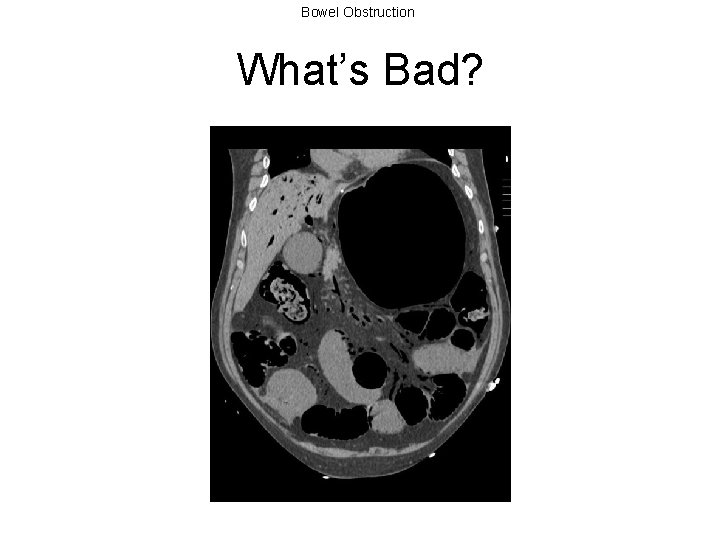 Bowel Obstruction What’s Bad? 