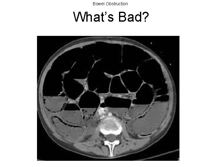 Bowel Obstruction What’s Bad? 