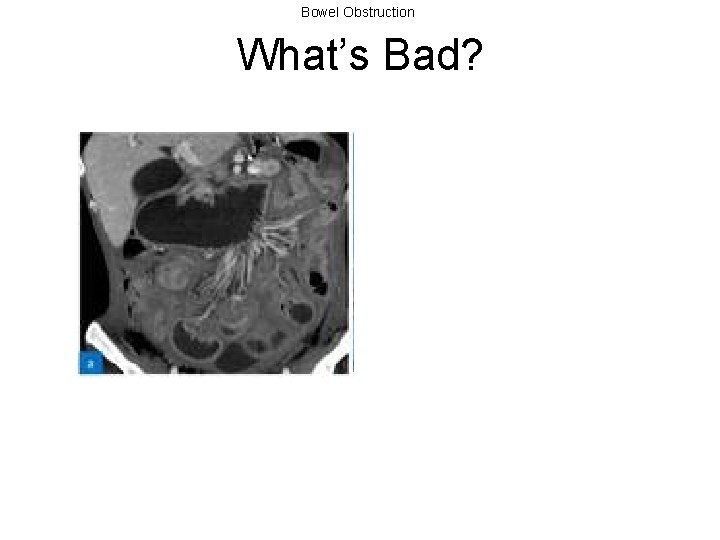 Bowel Obstruction What’s Bad? 