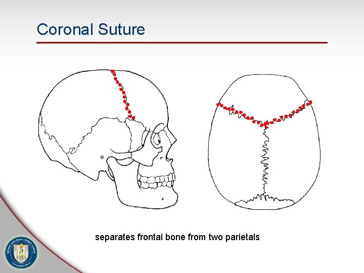 Coronal Suture separates frontal bone from two parietals 