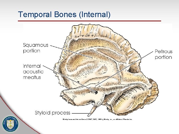 Temporal Bones (Internal) 