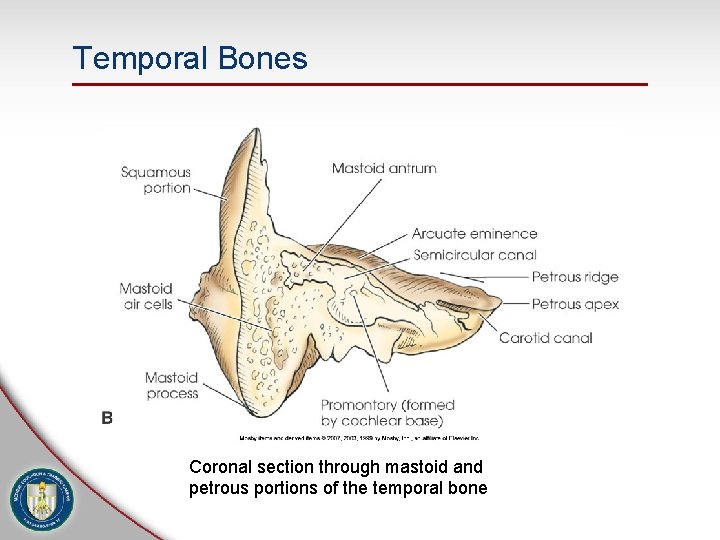 Temporal Bones Coronal section through mastoid and petrous portions of the temporal bone 