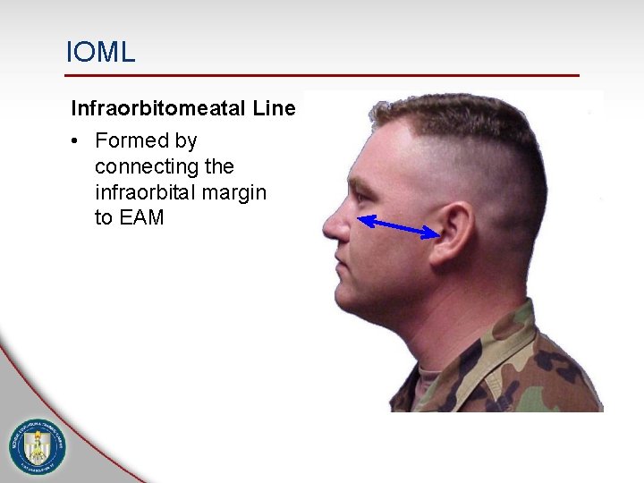 IOML Infraorbitomeatal Line • Formed by connecting the infraorbital margin to EAM 